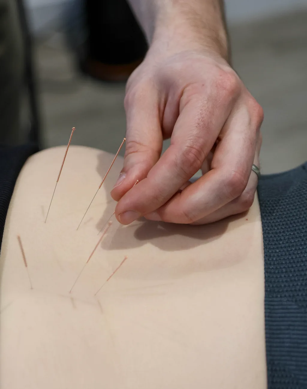 Medical acupuncture at BetterMe Physiotherapy